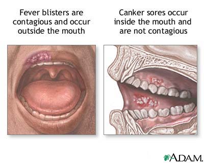 Fever blister Fever blister