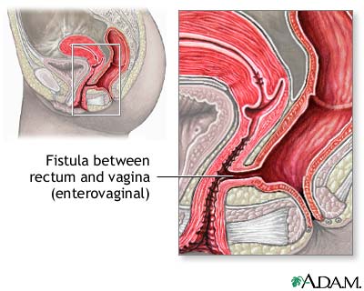 Fistula Fistula
