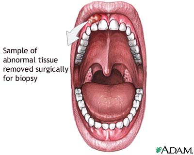 Gum biopsy