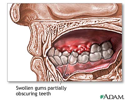 Swollen gums