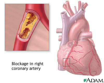 Coronary artery blockage Coronary artery blockage