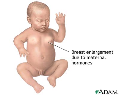 Hormonal effects in newborns