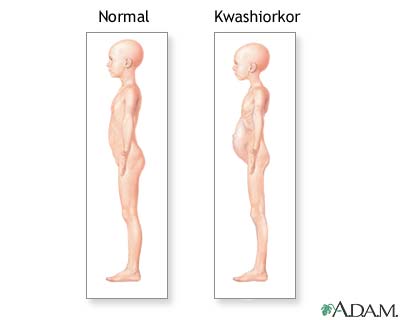 Kwashiorkor symptoms Kwashiorkor symptoms