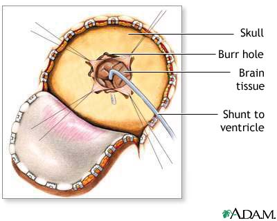 Craniotomy for cerebral shunt Craniotomy for cerebral shunt