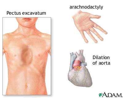 Marfan's syndrome Marfan's syndrome