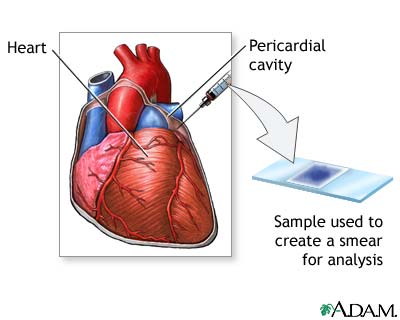 Pericardial fluid stain Pericardial fluid stain