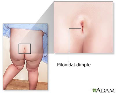 Pilonidal cyst and dimple Pilonidal cyst and dimple