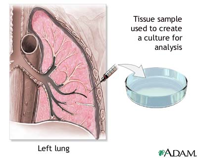 Pleural culture Pleural culture