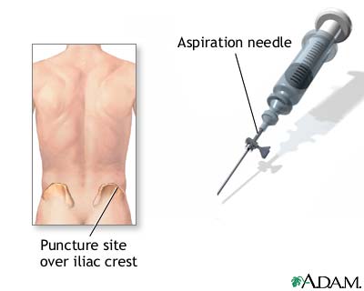 Bone biopsy