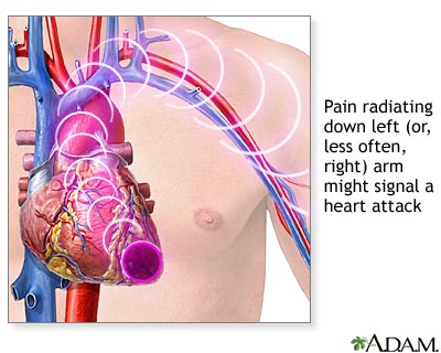 Heart attack symptoms Heart attack symptoms