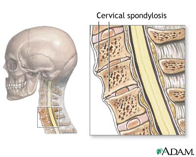 Cervical spondylosis Cervical spondylosis