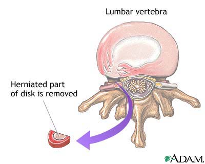 Herniated disk repair Herniated disk repair
