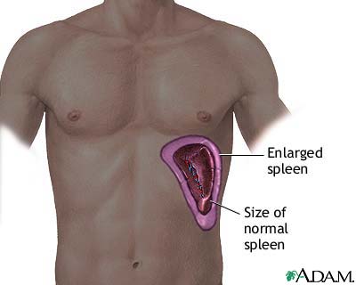 Enlarged spleen Enlarged spleen