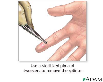 Splinter removal