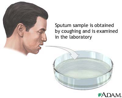 Sputum test Sputum test