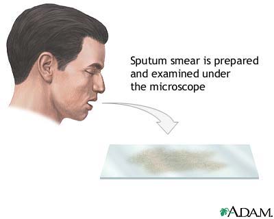 Sputum test Sputum test