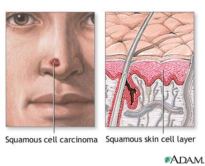 Squamous cell cancer Squamous cell cancer