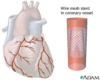 Coronary artery stent Coronary artery stent