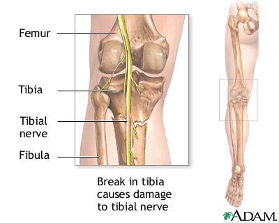 Tibial nerve Tibial nerve