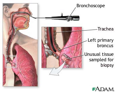 Bronchoscope Bronchoscope