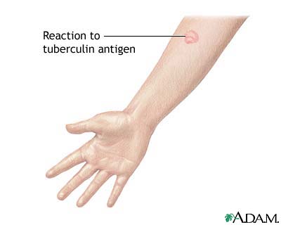 Tuberculin skin test Tuberculin skin test