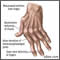 Rheumatoid arthritis