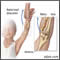 Radial head injury