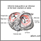 Infective endocarditis