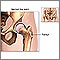 Hip joint replacement - series