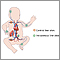 Intravenous fluid sites