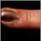 Skin cancer, melanoma on the fingernail