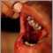 Pemphigus, vulgaris - lesions in the mouth