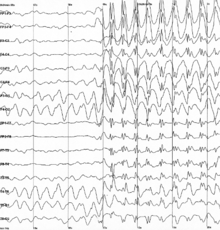 Graph showing 16 voltage traces going across the page from left to right, each showing a different signal. At the middle of the page all of the traces abruptly begin to show sharp jerky spikes, which continue to the end of the plot.