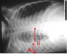 An X-ray showing a chest lying horizontal. The lower black area which is the right lung is smaller with a whiter area below it of a pulmonary effusion. There are red arrows marking the size of these.